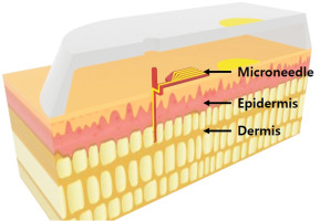 Reduced graphene oxide-functionalized polymer microneedle for continuous and wide-range monitoring of lactate in interstitial fluid